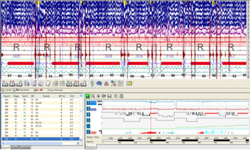 Obstructive Sleep Apnea Events in REM Sleep