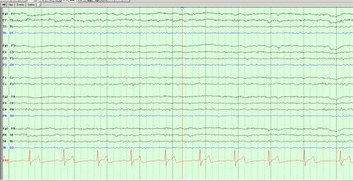 image sample of eeg recording